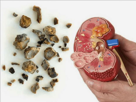 Obat Alami Batu Ginjal